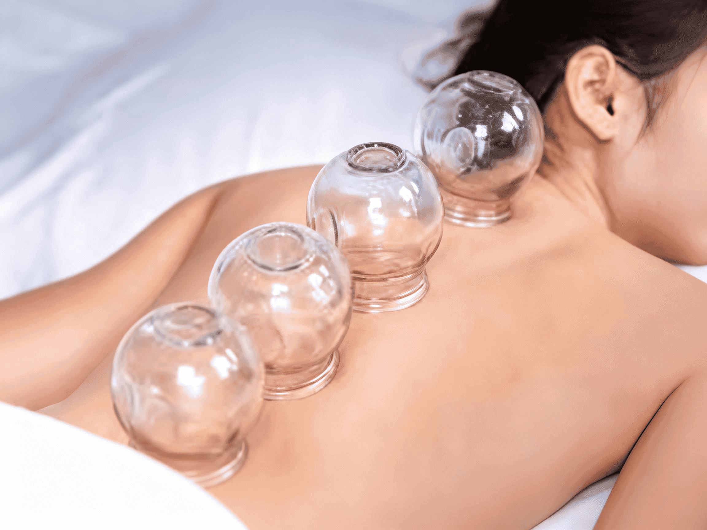 Glass cupping vessels arranged along the back of a resting figure